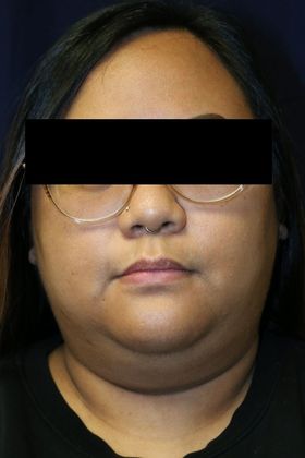 Neck Sculpting : Case 2 - Before