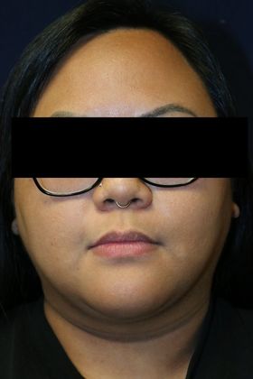 Neck Sculpting : Case 2 - After