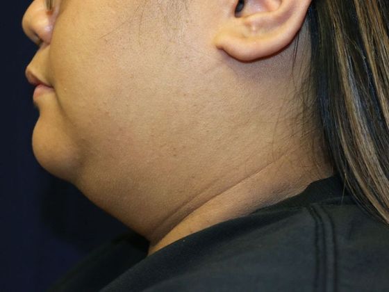 Neck Sculpting : Case 2 - Before