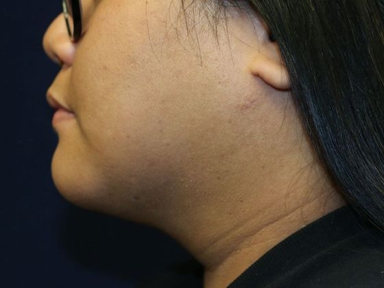 Neck Sculpting : Case 2 - After