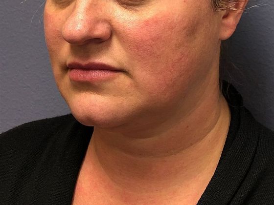KYBELLA™ *: Kybella 1 - After