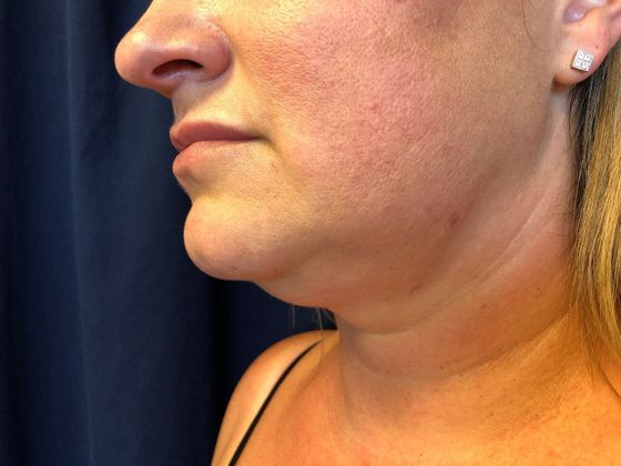 KYBELLA™ *: Kybella 1 - Before