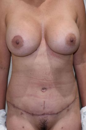 Mommy Makeover Case 204 - After