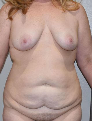 Mommy Makeover Case 206 - Before