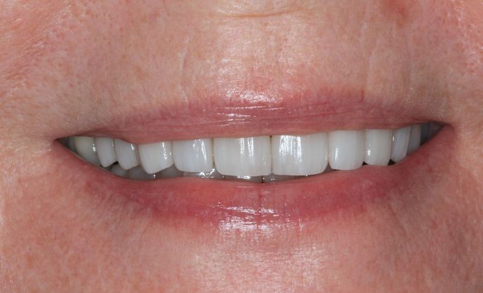 Full Mouth Reconstruction: Case 25 - After