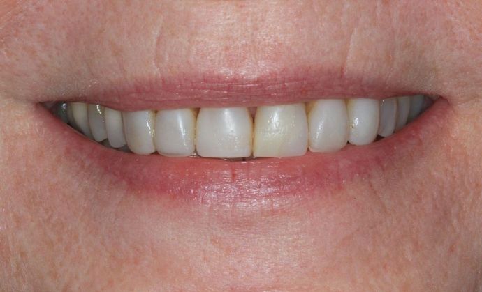 Full Mouth Reconstruction: Case 25 - Before