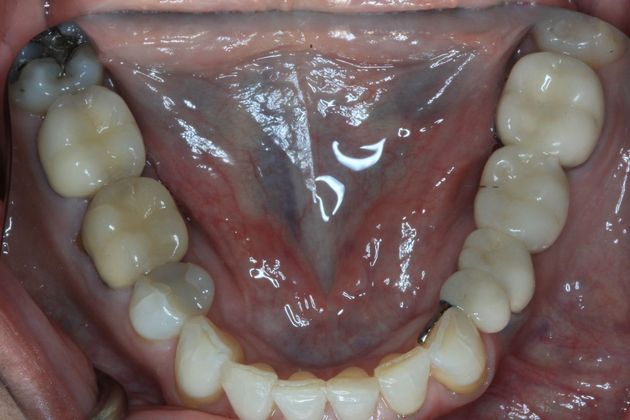 Full Mouth Reconstruction: Case 26 - Before