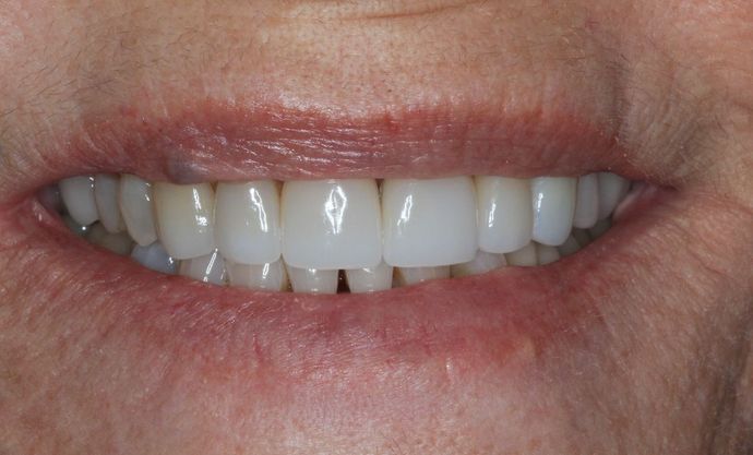 Full Mouth Reconstruction Case 26 - Before