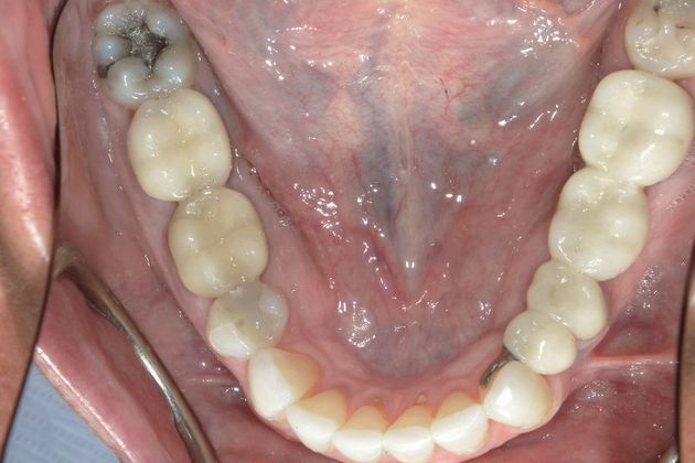 Full Mouth Reconstruction: Case 26 - After