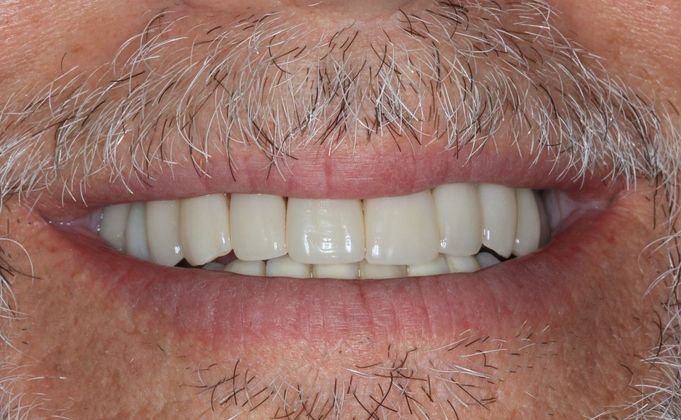 Full Mouth Reconstruction: Case 27 - Before