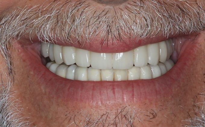 Full Mouth Reconstruction: Case 27 - After