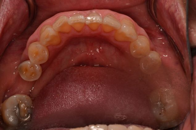 Dental Implants: Case 52 - Before implants