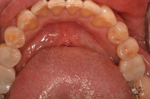 Dental Implants: Case 52 - After three implants
