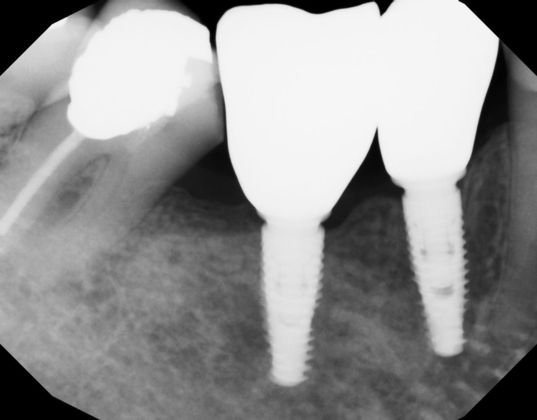 Dental Implants: Case 52 - Radiograph of two lower right implants