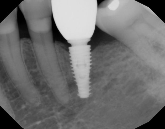 Dental Implants: Case 52 - Radiograph of lower left implant