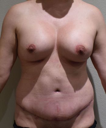 Mommy Makeover Case 207 - After