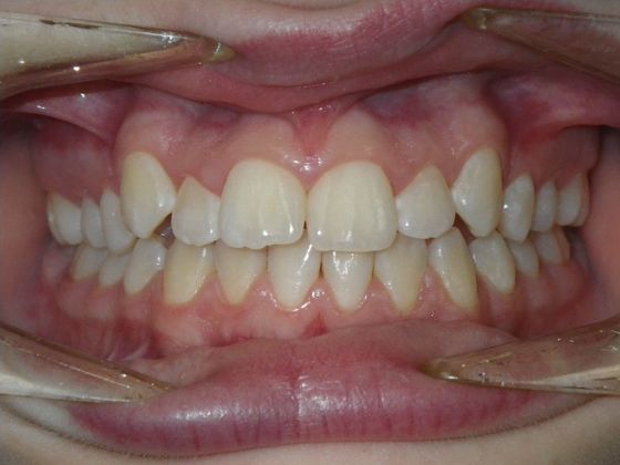 Orthodontics: Case 31 - Before