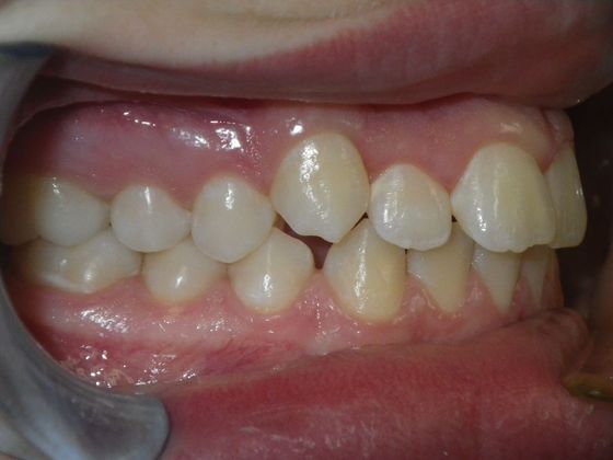 Orthodontics: Case 31 - Before
