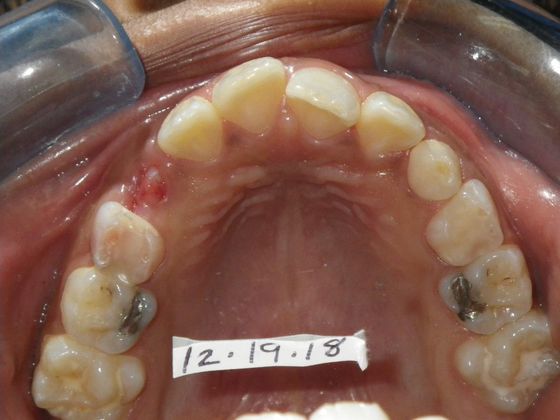 Orthodontics: Case 32 - Before