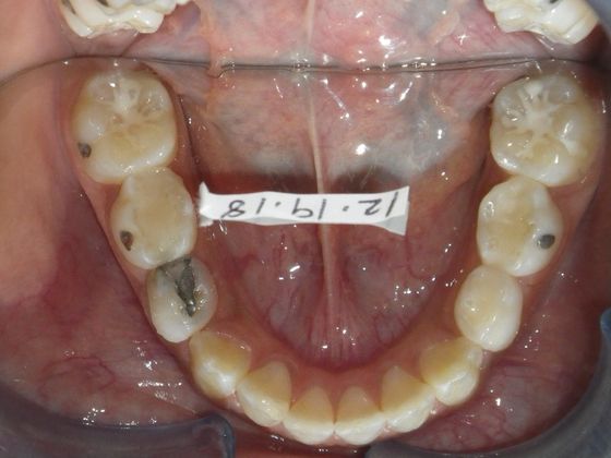 Orthodontics: Case 32 - Before