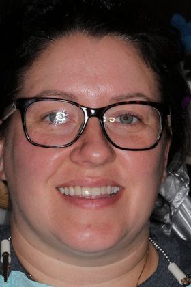 Veneers Case 20 - Before