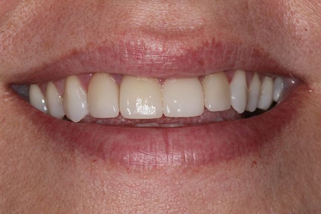 Veneers: Case 20 - Before
