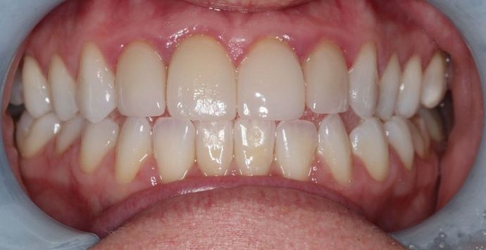 Veneers: Case 20 - Before