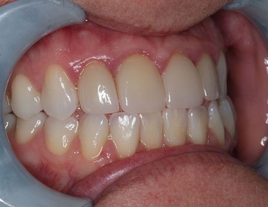 Veneers: Case 20 - Before