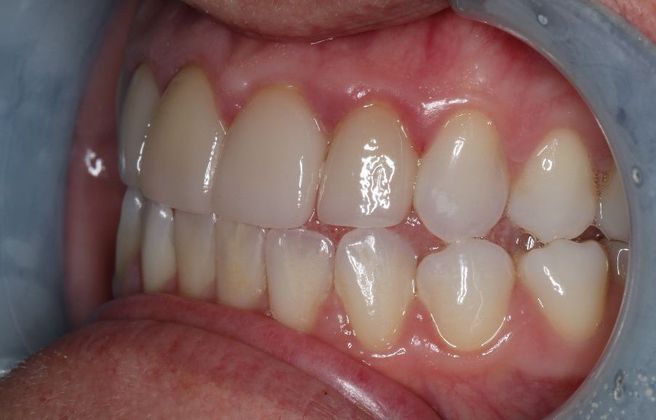 Veneers: Case 20 - Before