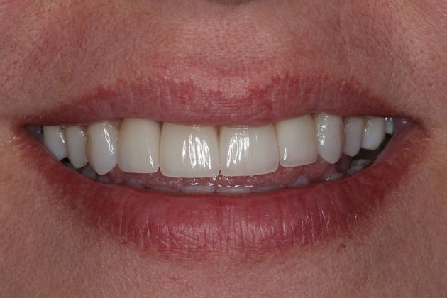 Veneers: Case 20 - After