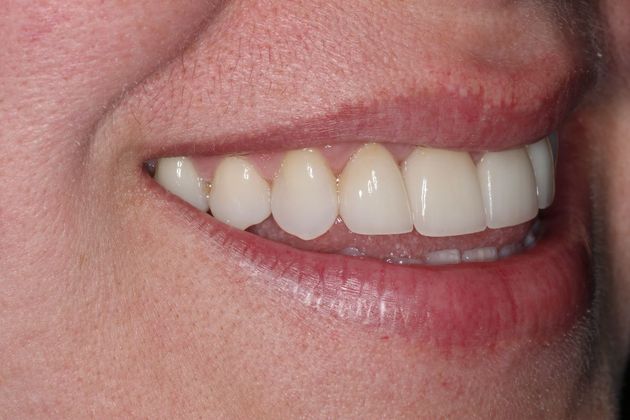 Veneers: Case 20 - After