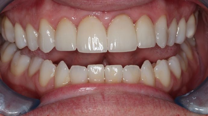Veneers: Case 20 - After
