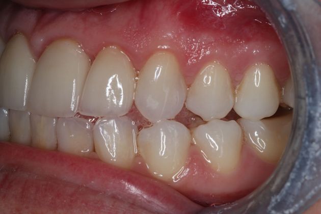Veneers: Case 20 - After