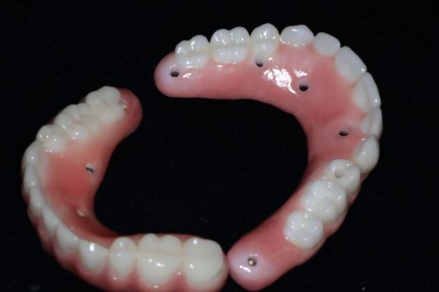 Teeth In A Day: Case 23 - Upper Lower Prosthetic