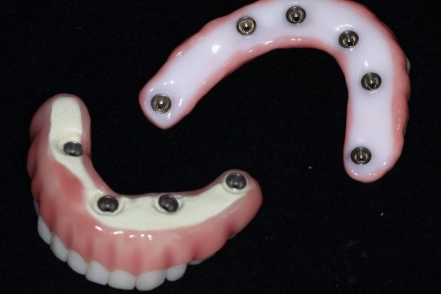 Teeth In A Day: Case 23 - Upper Lower Prosthetic