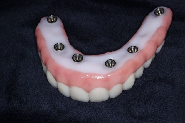 Teeth In A Day: Case 23 - Upper Prosthetic