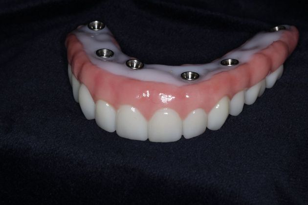 Teeth In A Day: Case 23 - Upper Prosthetic