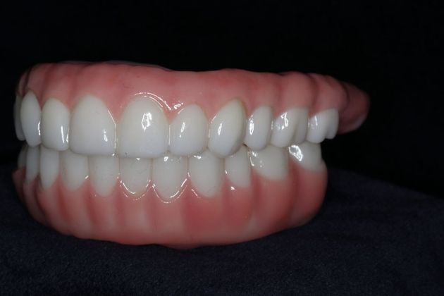 Teeth In A Day: Case 23 - Upper Lower Prosthetic