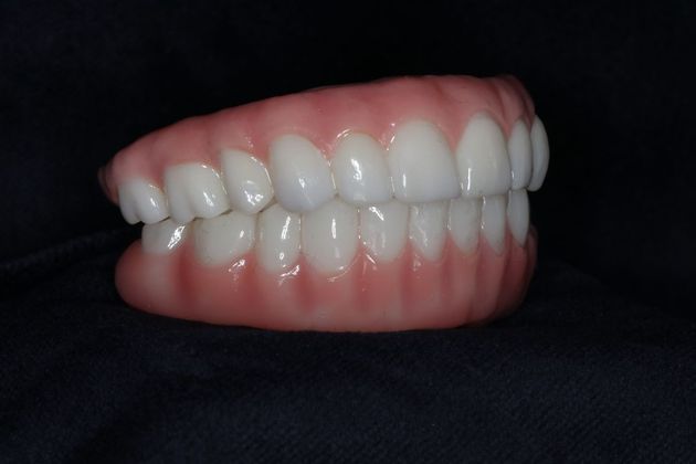 Teeth In A Day: Case 23 - Upper Lower Prosthetic