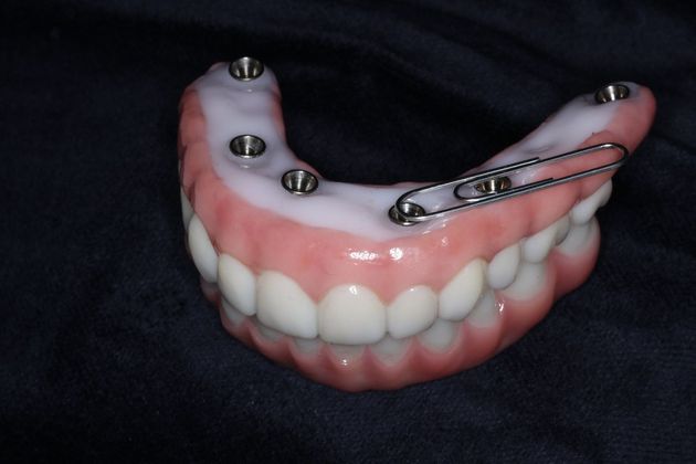 Teeth In A Day: Case 23 - Paper Clip Reference Size