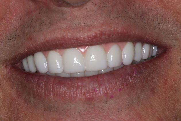 Teeth In A Day Case 23 - After