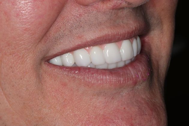 Teeth In A Day: Case 23 - Prosthetic in Place