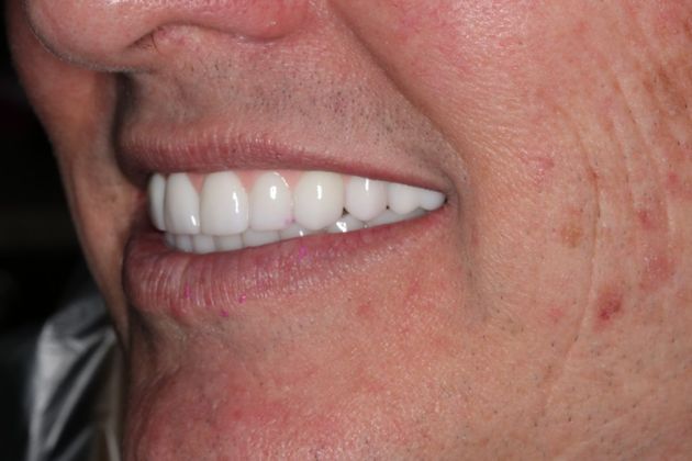 Teeth In A Day: Case 23 - Prosthetic in Place