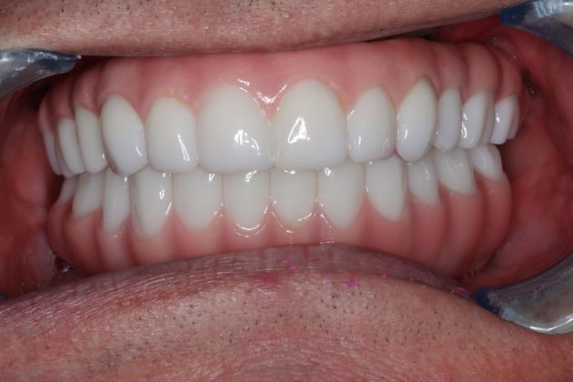 Teeth In A Day: Case 23 - Prosthetics in Place