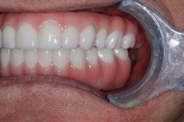 Teeth In A Day: Case 23 - Prosthetics in Place