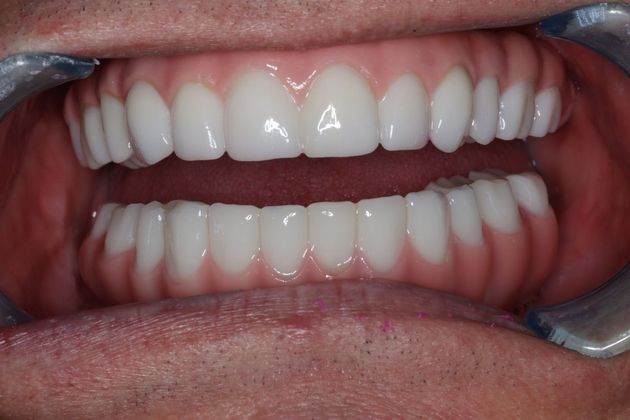 Teeth In A Day: Case 23 - Prosthetics in Place