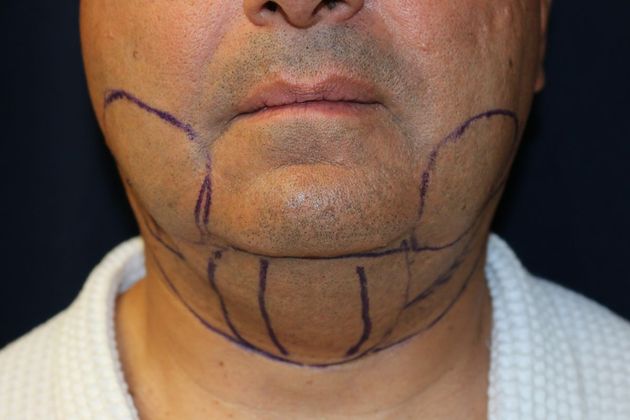 Neck Sculpting : Case 10 - Before