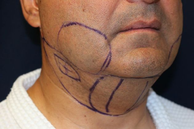 Neck Sculpting : Case 10 - Before