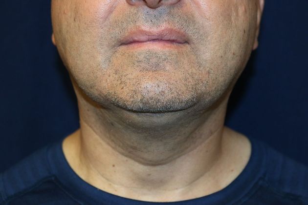 Neck Sculpting : Case 10 - After