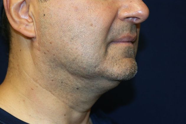 Neck Sculpting : Case 10 - After